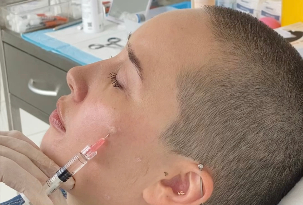 BioRemodelling Injections Explained Cost, Before & After, And Review